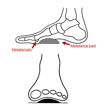 Pedag Metatarsal Pad